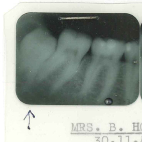 X-rays of the teeth of Barbara Hoyle, Fred's wife. Hoyle papers 108/4/1.