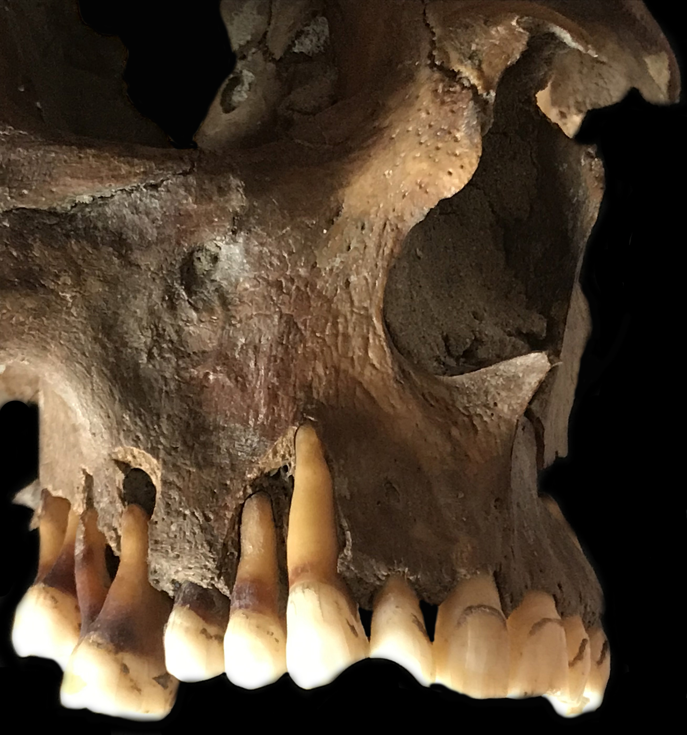 Teeth of a pipe smoker from the 17th century